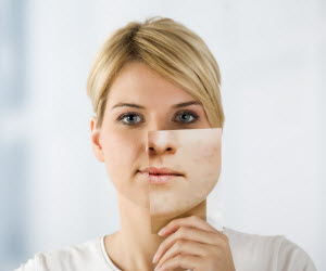 Hoe Krijg je Acne en hoe Helpt Arganolie het Voorkomen?